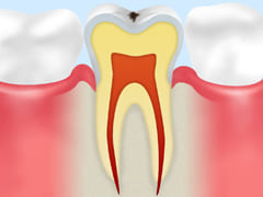 C0：ごく初期の虫歯「脱灰」