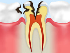 C3：歯の神経にまでおよんだ虫歯