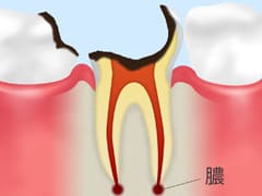 C4：歯根に達した虫歯