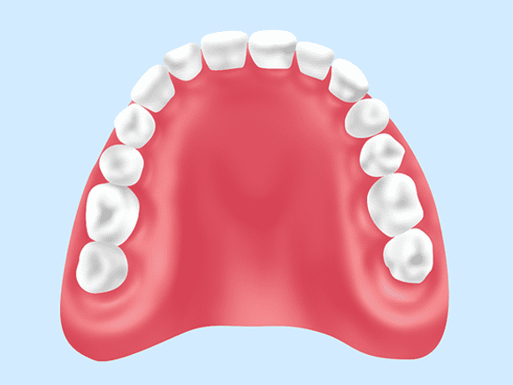 レジン床義歯