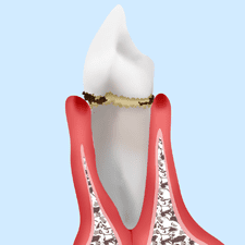 軽度歯周病の場合