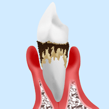 重度歯周病の場合