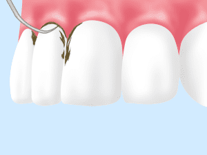 1 手術前に行う歯周基本治療