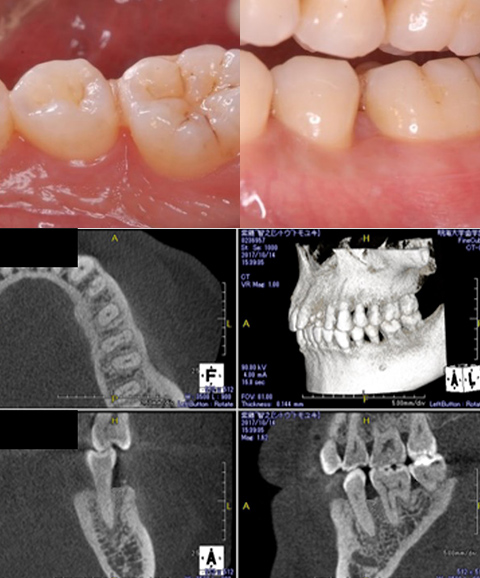 歯周組織再生療法