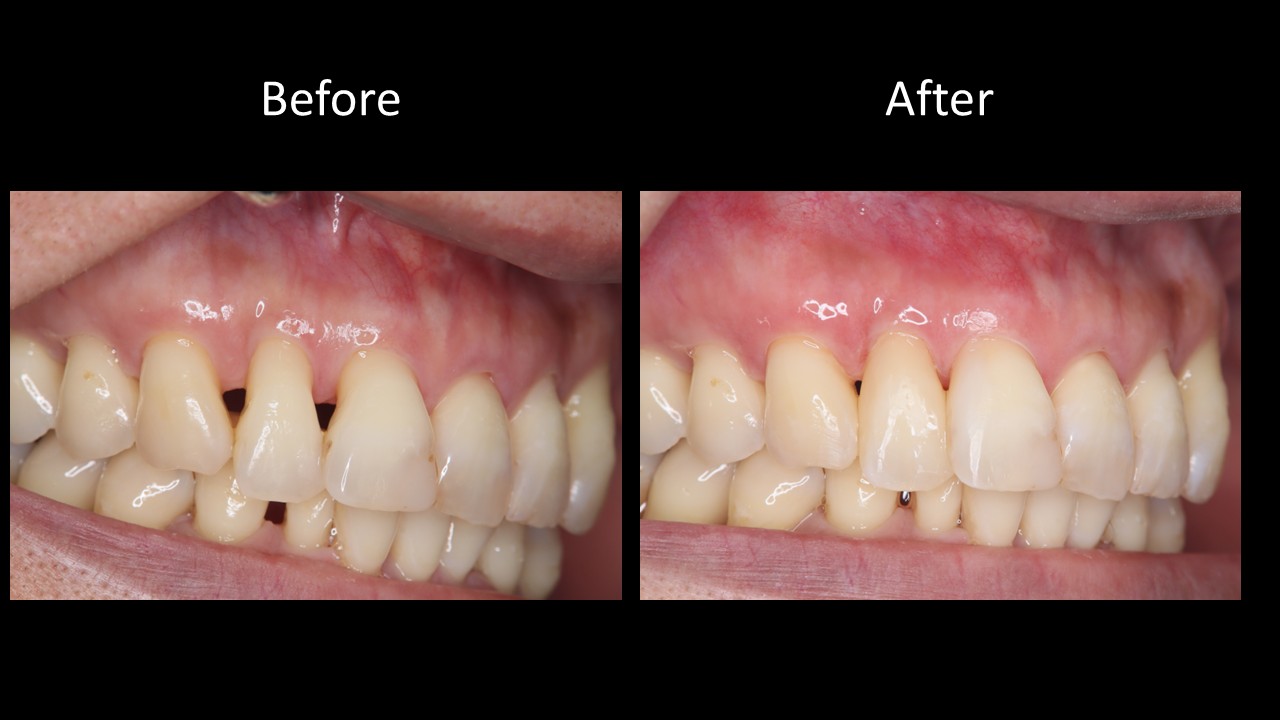 歯と歯の間が黒いのが気になる！