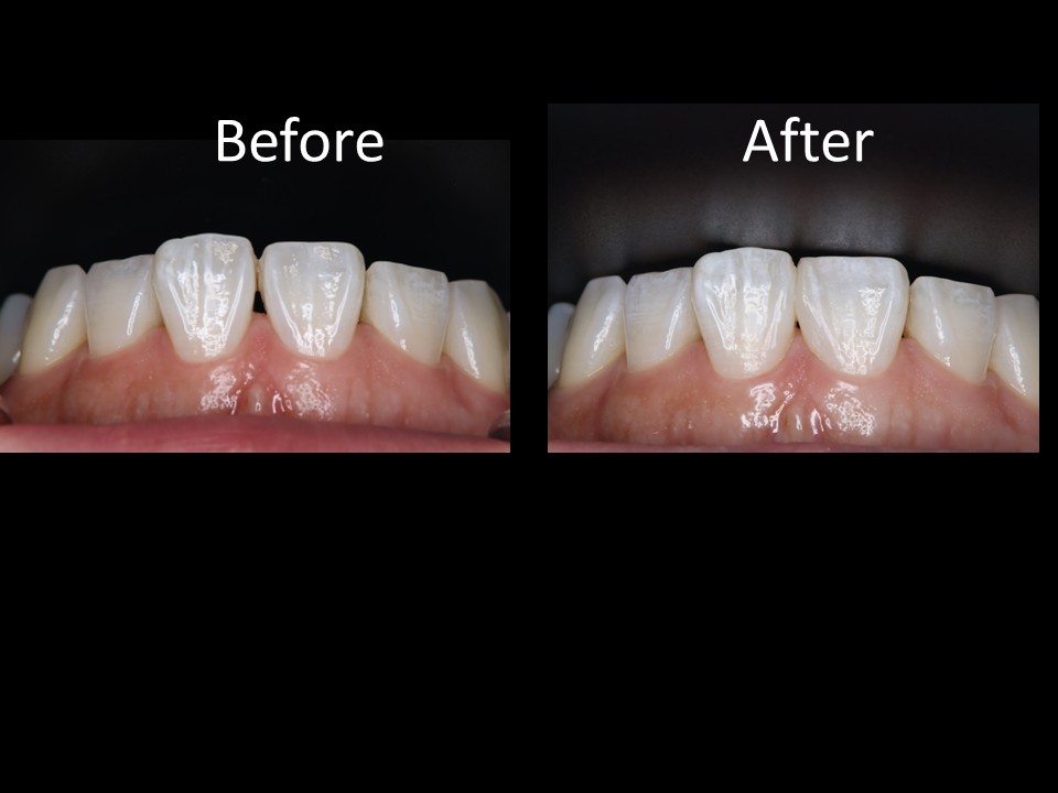 前歯の黒い隙間が気になる方へ｜40代女性の症例と治療方法