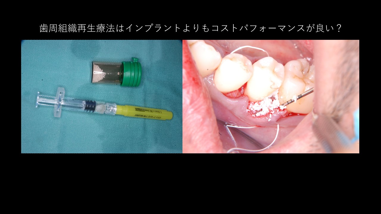 歯周組織再生療法はインプラントよりもコストパフォーマンスが良い？