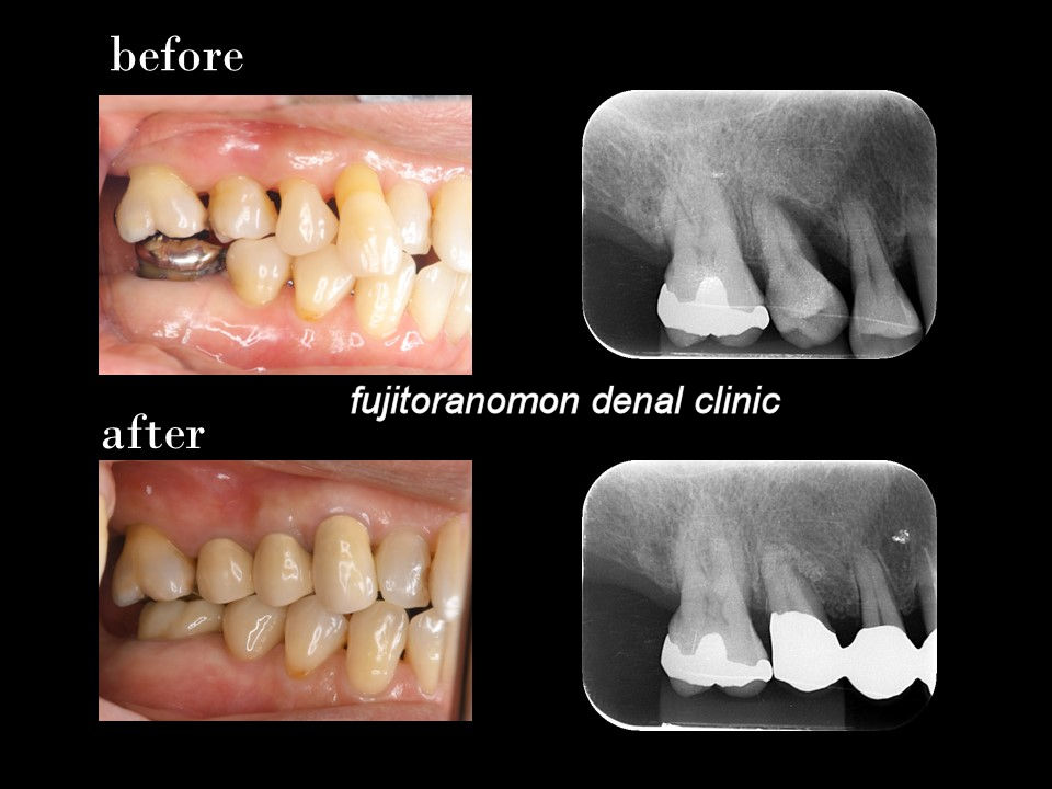 歯周病によってグラグラになった歯を改善した症例