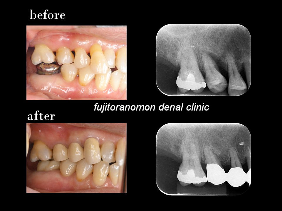 ひび割れた歯の合併症