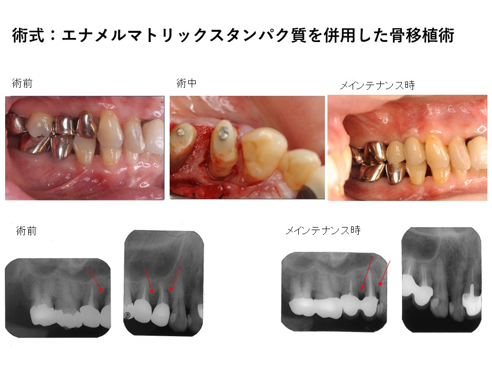 歯周病によって失った骨を再生した症例